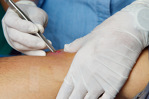 Abscess Drainage - Velura Clinic